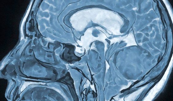 Hypnose bei Hirnoperationen: Größerer Tumoranteil durch moderne Techniken entfernbar
