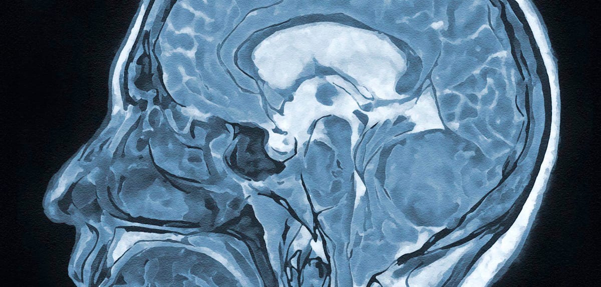 Hypnose bei Hirnoperationen: Größerer Tumoranteil durch moderne Techniken entfernbar