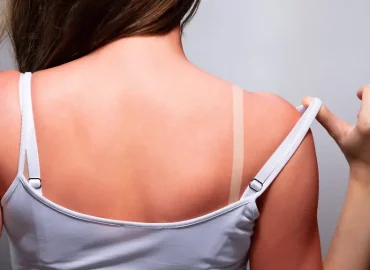 „Tanmaxxing“: Gefährlicher Trend und seine Gesundheitsrisiken