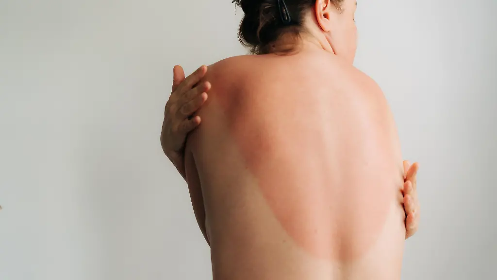 Krebsrisiko durch UV-Strahlung: Der Einfluss von Sonnenbränden